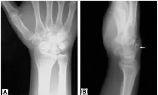Fig. 2. Cancellous connection was found between mass and