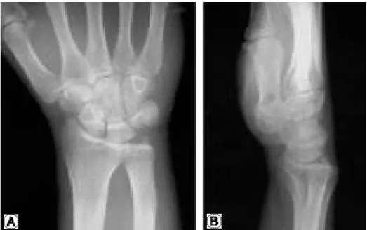 Fig. 4. Postoperative radiograph shows clear margin between hamate and capitate.