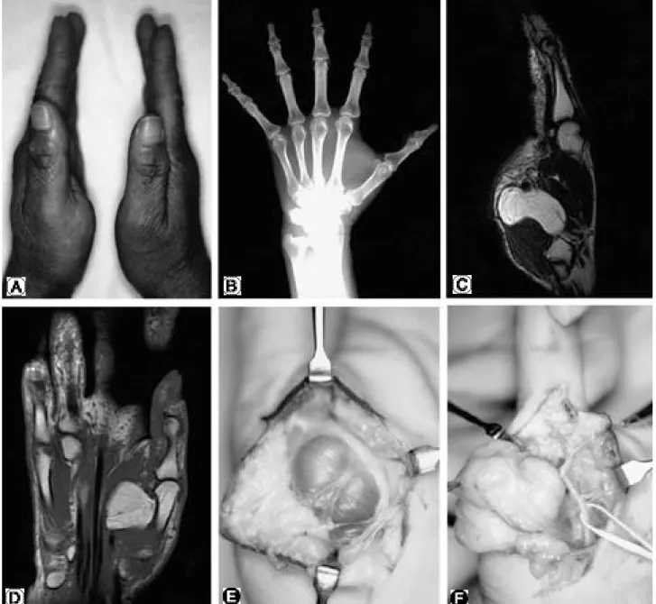 Fig. 1. A. The hands of a fifty-six years old woman, who had a painless, gradually enlarging mass in the thenar eminence on the left for one year