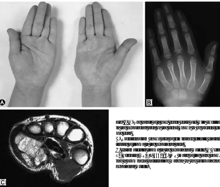 Fig. 2. A. The hands of a boy, seven years old, with swelling in the hypothenar area on the right, known to be present for one year