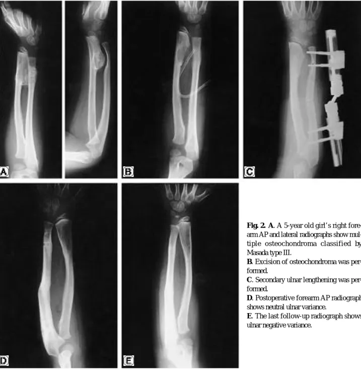 Fig. 2. A. A 5-year old girl’s right fore- fore-arm AP and lateral radiographs show  mul-tiple  osteochondroma  classified  by Masada type III