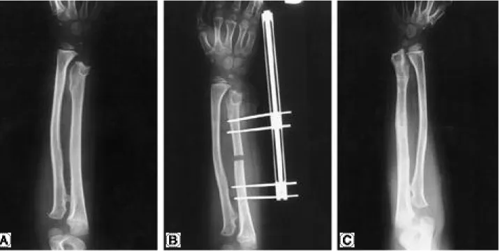 Fig. 3. A. A 6-year old boy’s right forearm AP radiograph shows multiple osteochondroma classified by Masada type IIb