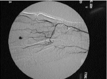 Figure 2. Intraoperative photography views the hematoma from proper digital artery injury occurred at second web space after percutaneous A1 pulley release.