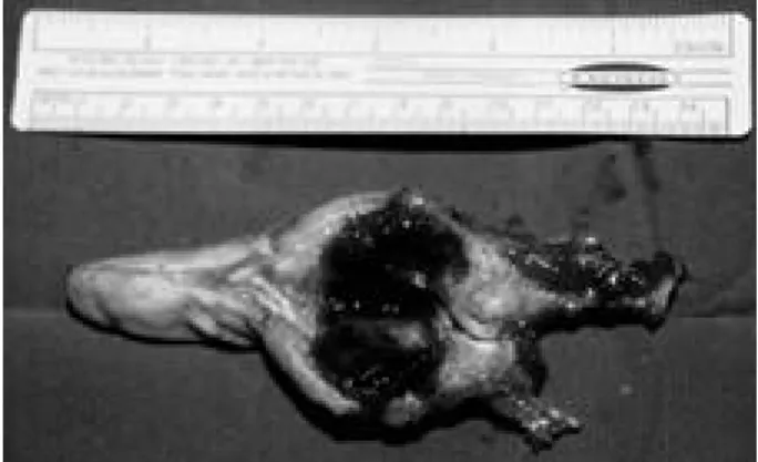 Fig. 3. Photomicrograph consistent with diagnosis of giant- giant-cell tumor of bone (A) Numerous proliferating mononuclear cells with poorly defined cytoplasm surround interspersed multinucleated giant cells