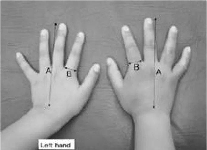 Fig. 1. Photograph showing mild asymmetry of right hand. A.