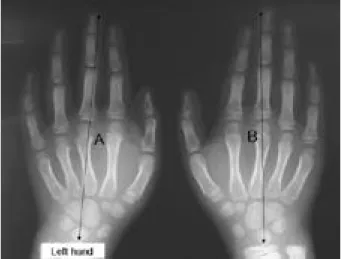Fig. 2. Radiograph demonstrates that the length of phalangeal and metacarpal bone of right hand are slightly more longer than that of light hand