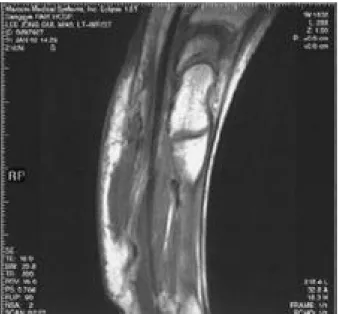 Fig. 2. After closed reduction, anatomical reduction of the sec- sec-ond and third carpometacarpal joints is showed in these films.