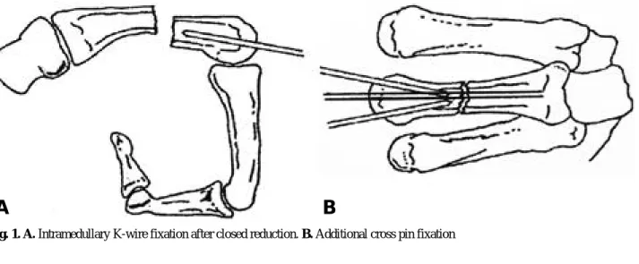 Fig. 1. A. Intramedullary K-wire fixation after closed reduction. B. Additional cross pin fixation