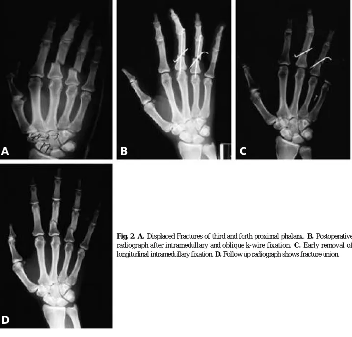 Fig. 2. A . Displaced Fractures of third and forth proximal phalanx.  B . P o s t o p e r a t i v e radiograph after intramedullary and oblique k-wire fixation