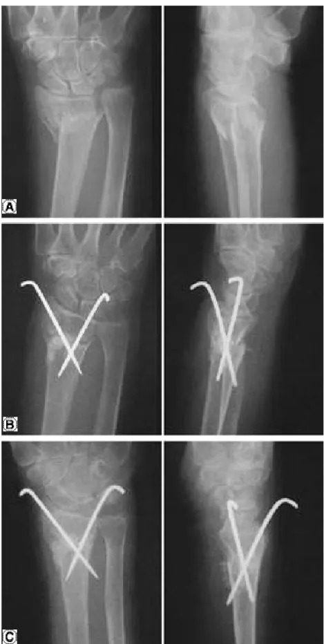 Fig. 2. A. Dorsal displaced comminution of distal radius. 72-year-old female. 
