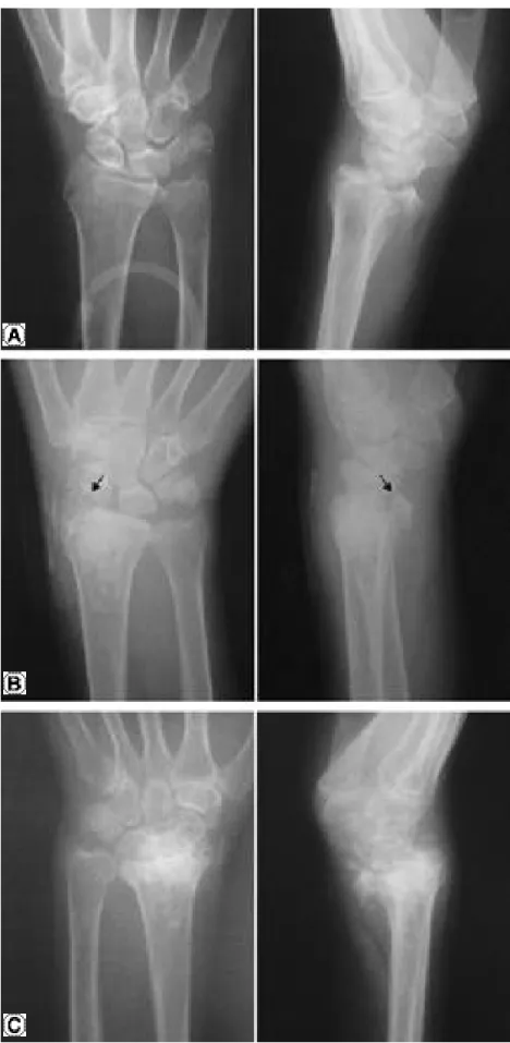 Fig. 3. A. Intraarticular fracture of distal radius. B. Leakage of bone cement int intraarticular space (arrow)
