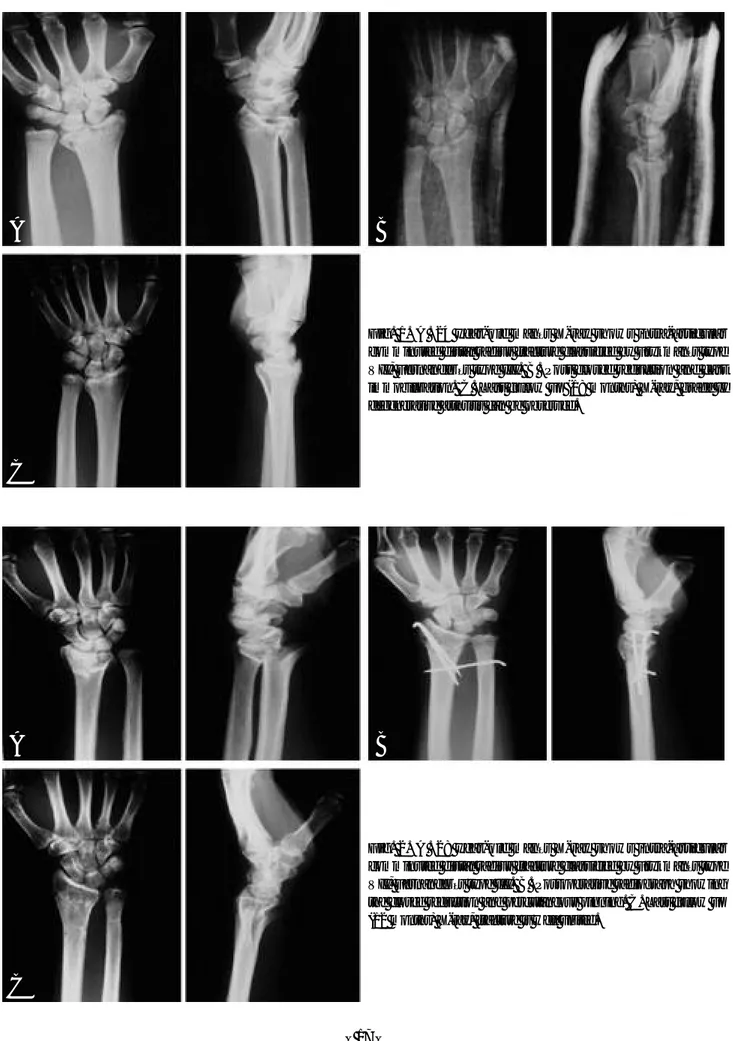 Fig. 1. A . 24 year-old man’s X-ray shows intra-articular comminuted distal radius fracture classified by Frykman’s type VII, Fernandez’s type III