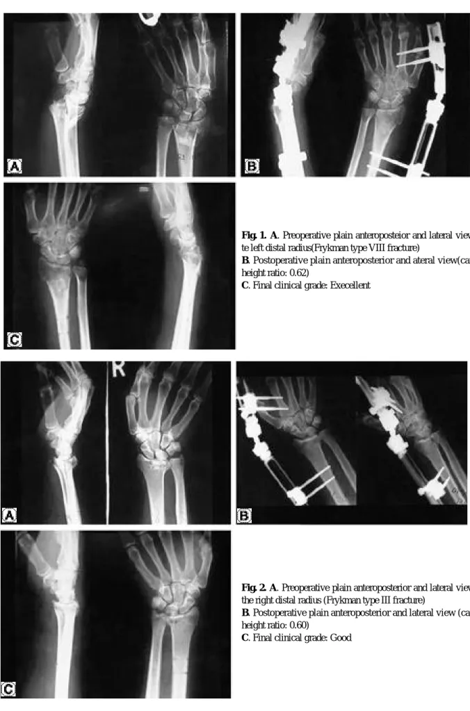 Fig. 1. A. Preoperative plain anteroposteior and lateral view of te left distal radius(Frykman type VIII fracture) 