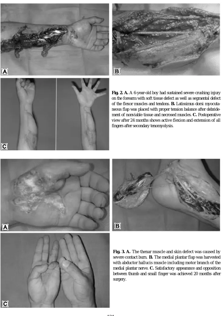 Fig. 2. A. A 6-year-old boy had sustained severe crushing injury on the forearm with soft tissue defect as well as segmental defect of the flexor muscles and tendons