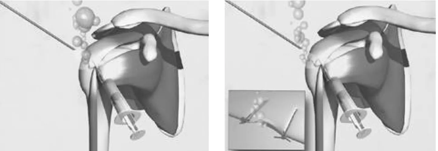 Fig. 1. The illustration shows air infusion technique for the detection of complete cuff tear.