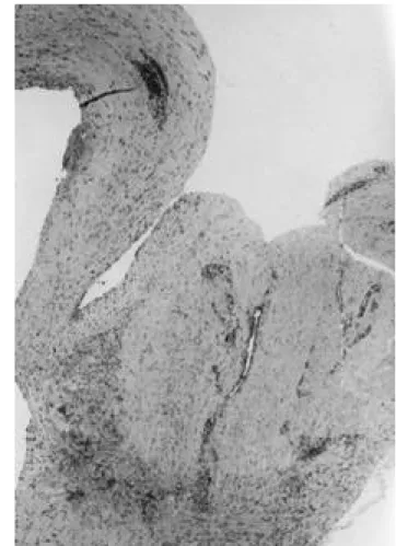 Fig. 3. Microscopic finding of the cyst wall shows synovial lin- lin-ing and diagnosed to ganglion.