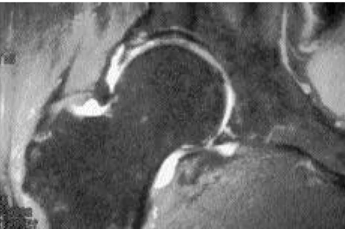 Fig. 2. This picture shows Bucket-handle type of complete detachment in the acetabular labral tear