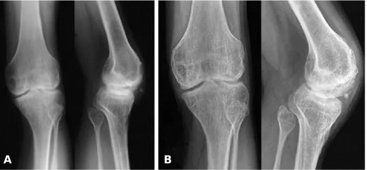 Fig. 2. (A) Preoperative radiograph of an 26-year-old patient with severe hemophilia A shows stage III radiographic findings.