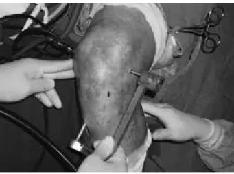 Fig. 1. Femoral tunnel was reamed 35 mm in depth for allow- allow-ing interference screw fixation after cross-pin fixation.