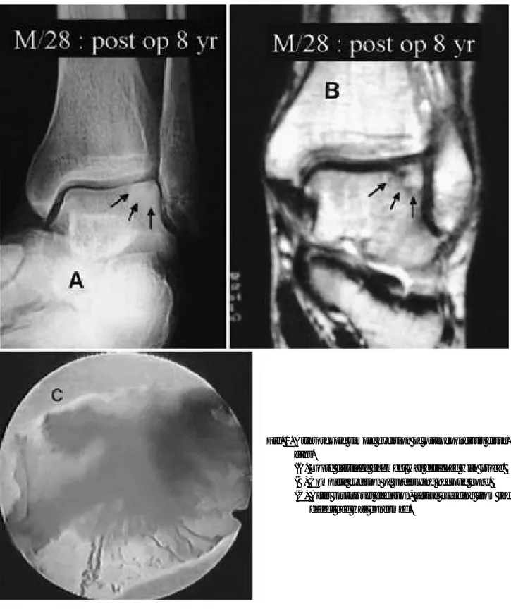 Fig. 1. Arthroscopic simple excision of osteochondritis disse- disse-cans.