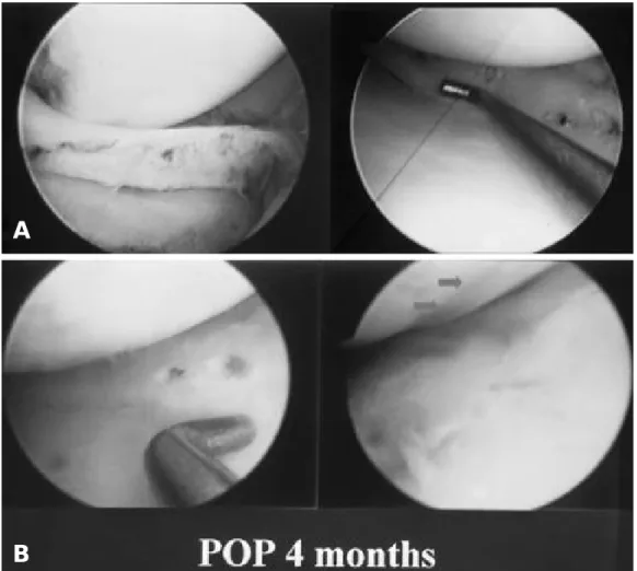 Fig. 1. (B) Second-look arthroscopy 4 months postoperatively reveal protruded T-shaped head of meniscus arrow and femoral condyle injury.