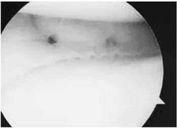 Fig. 1. Arthroscopic finding shows meniscus repaired with all- all-inside technique using two arrows.