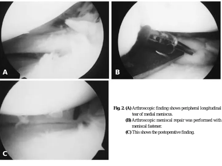Fig. 2. (B) Arthroscopic meniscal repair was performed with meniscal fastener.