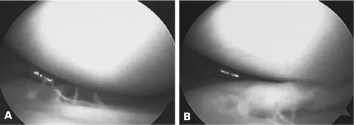 Fig. 2. (A) Atwenty-year old male patient shows that knee extension is well conserved its reduction by using a hook according to arthroscopic finding.