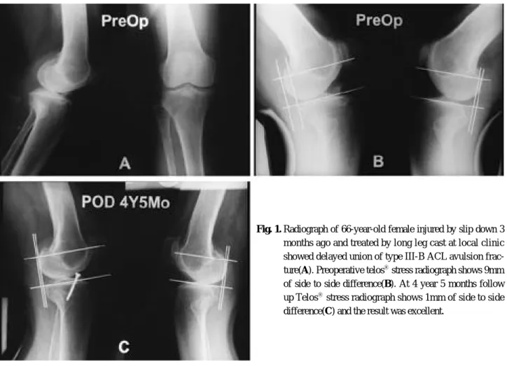 Fig. 1. Radiograph of 66-year-old female injured by slip down 3 months ago and treated by long leg cast at local clinic showed delayed union of type III-B ACL avulsion  frac-ture(A)