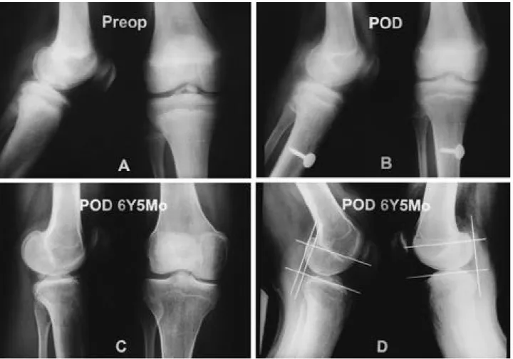 Fig. 2. Radiograph of 14-year-old male who were injured by traffic accident 7 months ago treated by long leg cast at local clinic showed delayed union of type IV ACL avulsion fracture(A)