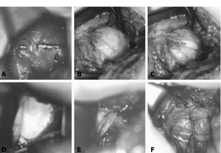 Fig. 1. Inferior capsular shift procedure using splitting subscapularis and capsule for instability of the shoulder