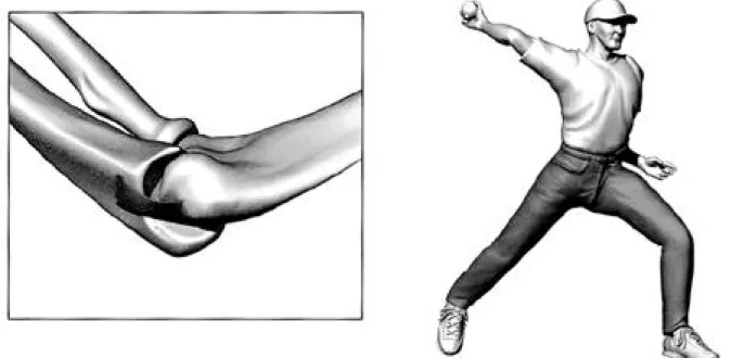 Fig. 2. Operation technique A, osteophytectomy through posteolateral portal &amp; straight posterior portal