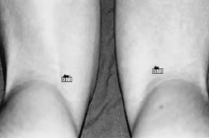 Fig. 4. AP radiograph of the right hip after operation. The hamstring was secured using two suture anchors.