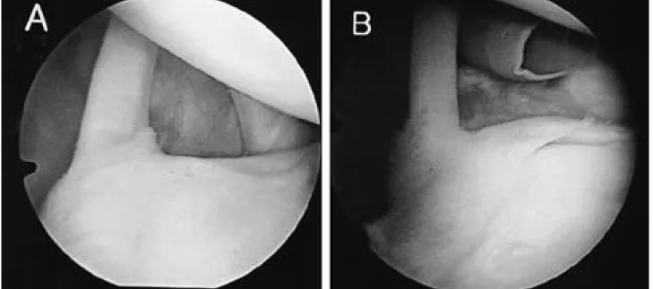 Fig. 1. Two types of Biceps-Superior Labrum attachment. A. Non-meniscoid type. B. Meniscoid type.