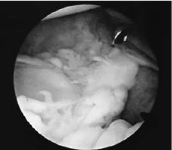 Fig. 5. Type II SLAP lesion. A . MR finding. B . Superior labrum and the biceps tendon anchor were torn away from the superior glenoid attachment.
