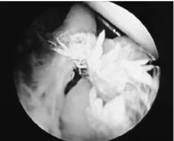 Fig. 8. Biceps load test I. The arm to be examined is abducted at 90˚ with the forearm in the supinated position.