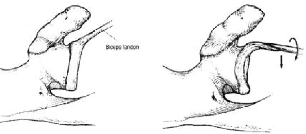 Fig. 1. Superior view of biceps-labral complex in resting and abducted externally position, showing peel-back mechanism as the biceps vector rotates posteriorly.