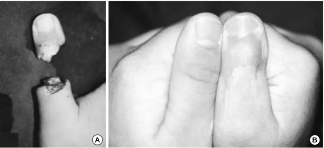 Fig. 1. (A) Guillotine type complete amputation of right thumb of 4 years-old female patient