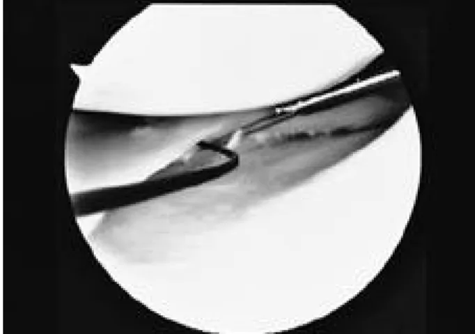 Fig. 6. Arthroscopic view shows vertically oriented suture Fig. 4. The end of suture of tibial surface is passed through