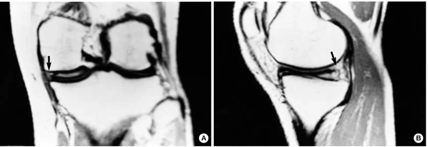 Fig. 1. MRI of the left knee: (A) A coronal image showing a medial discoid meniscus extending into the intercondylar notch