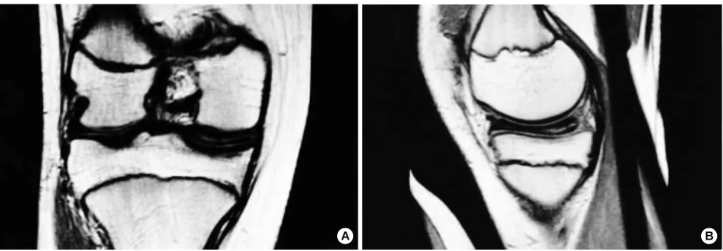 Fig. 3. MRI of the left knee: MRI of the right knee: (A) A coronal image showing a medial discoid meniscus extending into the intercondylar notch