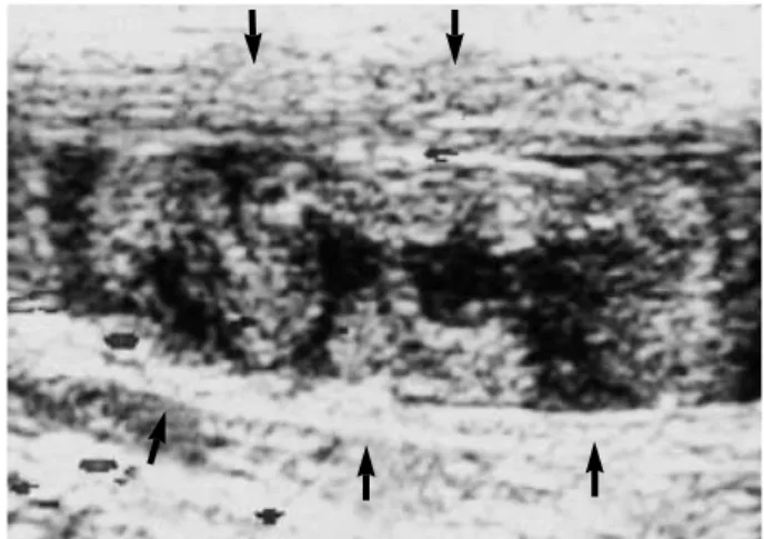 Fig. 1. High echoic serpentile figure shadow was seen on the USG of the distal forearm.
