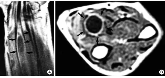 Fig. 2. On coronal section T1 (2A) weighted MRI, an oval  c-ystic intramuscular mass  wa-s wa-seen