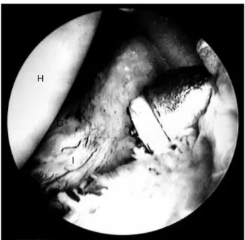 Fig. 2. This arthroscopic finding shows the release of the anterior inferior capsule of the right shoulder joint at the 4-5 o’ clock  posi-tion