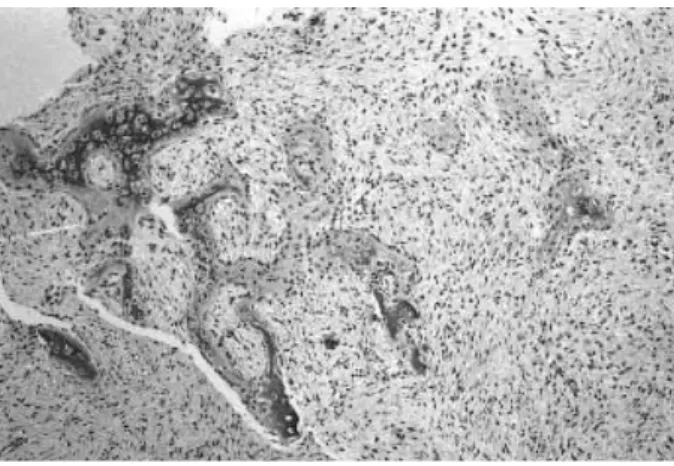 Fig. 1. Histological photograph showing irregular curved osteoid and mineralized trabeculae some of which are rimmed by osteoblasts within fibrous stroma