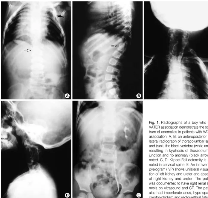 Fig. 1. Radiographs of a boy who had VATER association demonstrate the  spec-trum of anomalies in patients with VATER association
