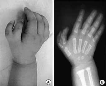 Fig. 3. A: Polydactyly of thumb in right hand as radial side anoma- anoma-ly, B: Plane radiograph of right hand.