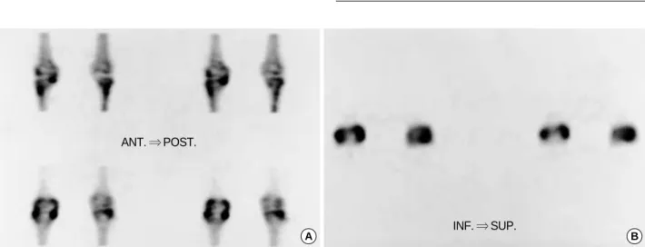 Fig. 1. Planar image of bone scan demonstrating an intense focus of accumulation on the medial aspect of the right knee but not definite.
