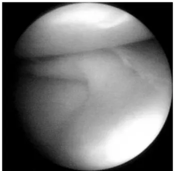 Fig. 3. Arthroscopic finding of same patient shows longitudinal tear of medial meniscus.