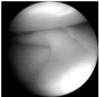 Fig. 3. Arthroscopic finding of same patient shows longitudinal tear of medial meniscus.